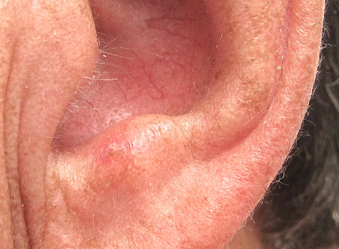 Example of actinic keratosis on the ear