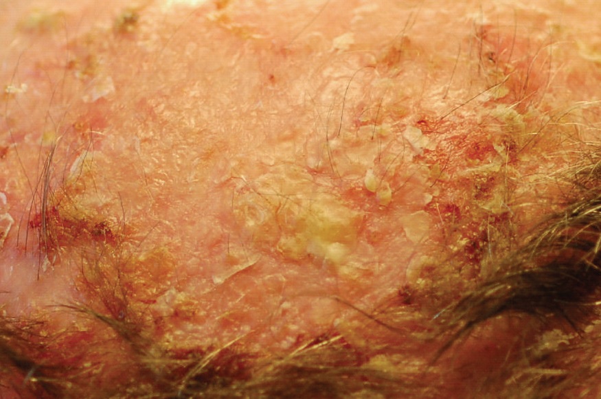 Example of actinic keratosis on the scalp