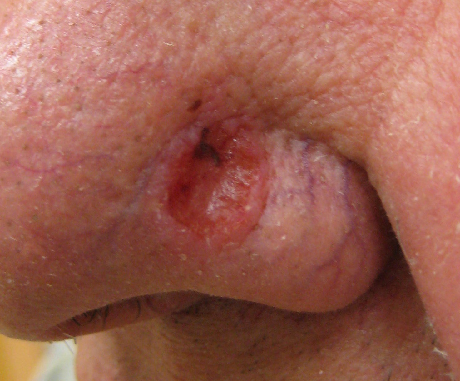 Example of basal cell carcinoma on the nose