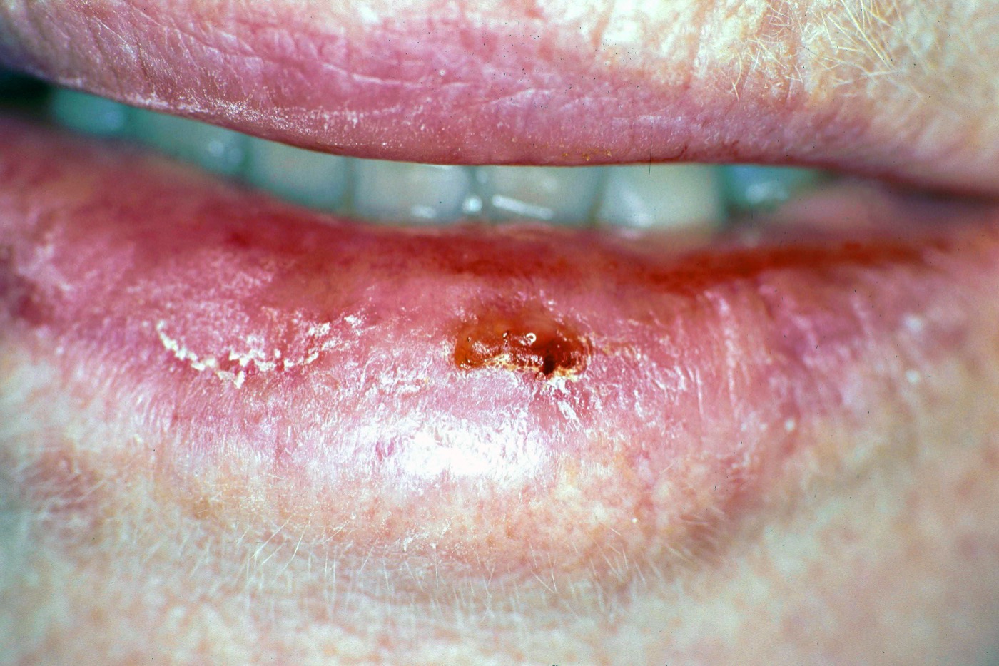 Example of squamous cell carcinoma on the lower lip