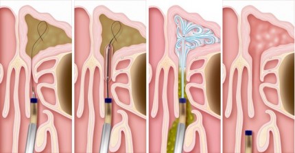 Balloon Sinuplasty Canton, GA