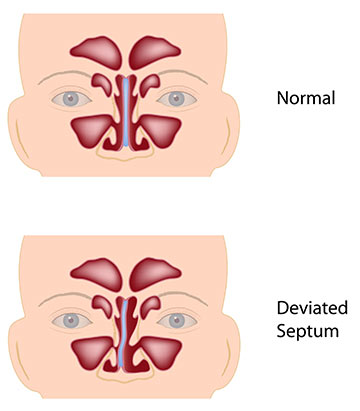 Deviated Septum Diagram Deviated Septum Diagram