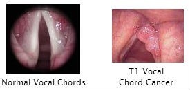 Hoarseness Examples