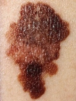 Malignant Melanoma Treatment Canton, GA