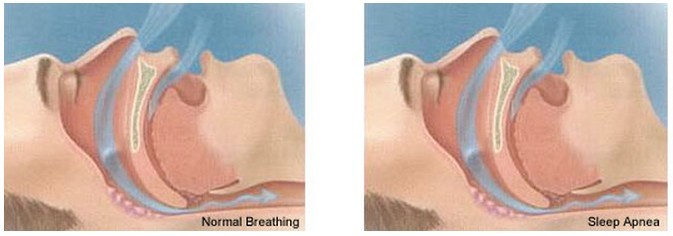 Sleep Apnea Diagram