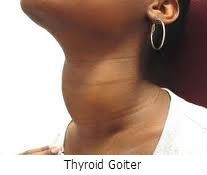 Thyroid Goiter Treatment in Canton, GA