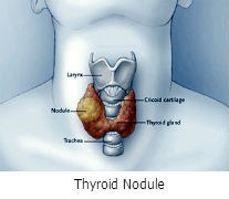 Thyroid Nodule Treatment in Canton, GA