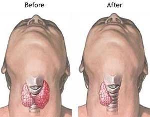 Thyroid Surgery