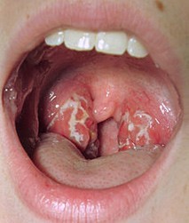 What Causes Tonsillitis? - Tonsillitis