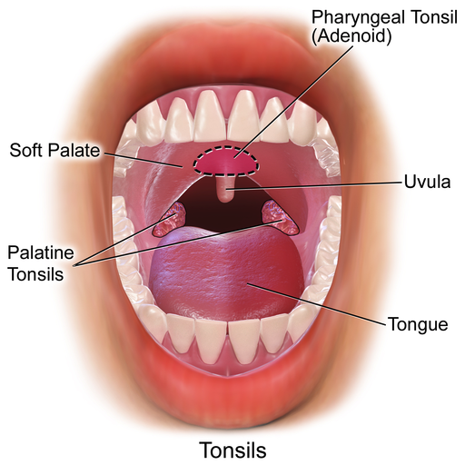 tonsillitis-and-when-is-tonsillectomy-needed